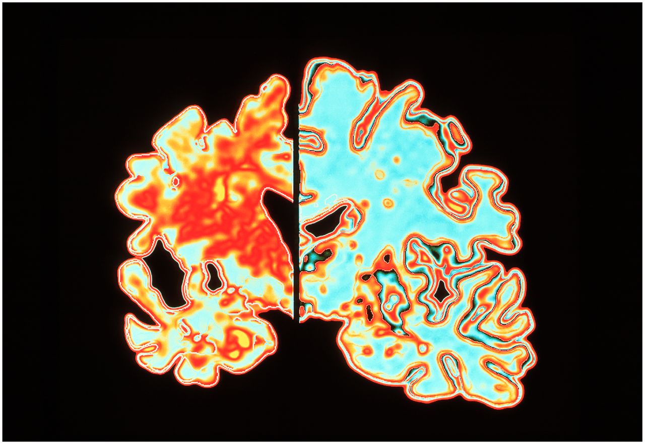 左侧为阿尔茨海默氏症患者大脑的彩色图像，右侧为健康大脑的彩色图像。